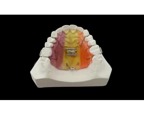 牙齿隐形矫正,矫治/矫治器/深圳义齿隐形义齿生产厂家